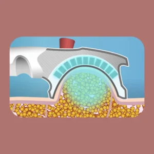 matériel de cryolipolyse pour médecin esthétique