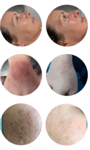 plasma froid 1